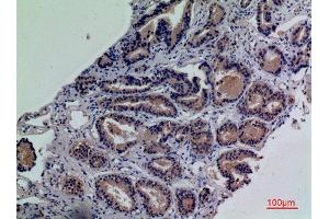 Immunohistochemistry (IHC) analysis of paraffin-embedded Human Prostate Cancer, antibody was diluted at 1:100.