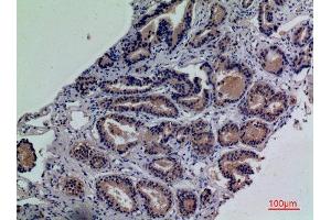 Immunohistochemistry (IHC) analysis of paraffin-embedded Human Prostate Cancer, antibody was diluted at 1:100. (ENPP3 anticorps  (Internal Region))