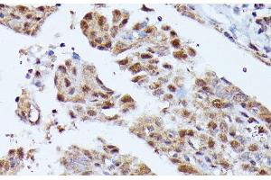 Immunohistochemistry of paraffin-embedded Human thyroid cancer using KIAA1429 Polyclonal Antibody at dilution of 1:100 (40x lens). (VIRMA/KIAA1429 anticorps)