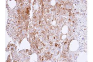IHC-P Image Immunohistochemical analysis of paraffin-embedded ES-2 xenograft , using UAP1, antibody at 1:500 dilution.