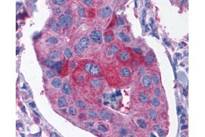 Anti-CCKBR / Cckb antibody IHC of human Breast, Carcinoma.