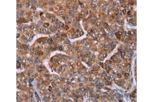 Immunohistochemistry of Human gastric cancer using HSPE1 Polyclonal Antibody at dilution of 1:40 (HSPE1 anticorps)