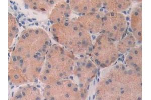 Detection of FGF19 in Human Stomach cancer Tissue using Polyclonal Antibody to Fibroblast Growth Factor 19 (FGF19)