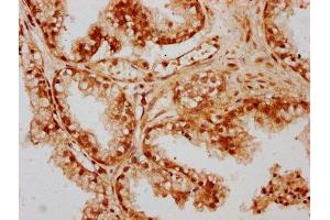 IHC image of ABIN7147479 diluted at 1:300 and staining in paraffin-embedded human prostate cancer performed on a Leica BondTM system. (GLTPD1 anticorps  (AA 1-214))