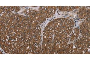 Immunohistochemistry of paraffin-embedded Human ovarian cancer tissue using FOLH1B Polyclonal Antibody at dilution 1:30 (FOLH1B anticorps)