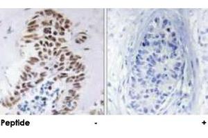 Immunohistochemical analysis of paraffin-embedded human lung carcinoma tissue using DAPK3 polyclonal antibody . (DAPK3 anticorps)
