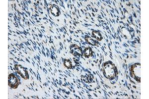 Immunohistochemical staining of paraffin-embedded Adenocarcinoma of breast tissue using anti-DCXR mouse monoclonal antibody. (DCXR anticorps)