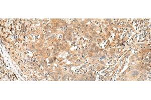 Immunohistochemistry of paraffin-embedded Human cervical cancer tissue using KCNA10 Polyclonal Antibody at dilution of 1:40(x200)