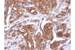 Formalin-fixed, paraffin-embedded human Breast Carcinoma stained with Cytokeratin 18 Mouse Monoclonal Antibody (KRT18/834).