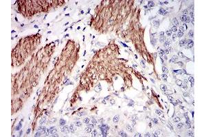Immunohistochemical analysis of paraffin-embedded esophageal cancer tissues using NPC1 mouse mAb with DAB staining.