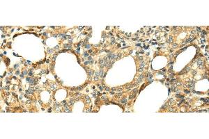 Immunohistochemistry of paraffin-embedded Human thyroid cancer tissue using SERPINA12 Polyclonal Antibody at dilution 1:40 (SERPINA12 anticorps)