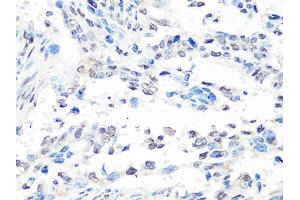 Immunohistochemistry of paraffin-embedded human lung cancer using MTA2 Antibody (ABIN4904441) at dilution of 1:100 (40x lens). (MTA2 anticorps)
