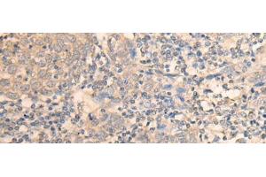 Immunohistochemistry of paraffin-embedded Human cervical cancer tissue using DAZ1 Polyclonal Antibody at dilution of 1:55(x200) (DAZ1 anticorps)