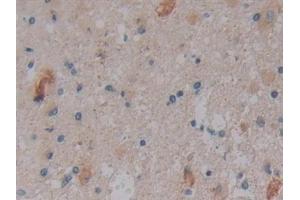 Detection of NOSTRIN in Human Glioma Tissue using Polyclonal Antibody to Nitric Oxide Synthase Trafficker (NOSTRIN) (NOSTRIN anticorps  (AA 18-251))
