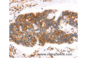 Immunohistochemistry of Human lung cancer using MLLT4 Polyclonal Antibody at dilution of 1:40 (Afadin anticorps)