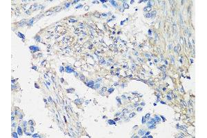 Immunohistochemistry of paraffin-embedded human lung cancer using MMP2 Antibody (ABIN5998246) at dilution of 1/100 (40x lens). (MMP2 anticorps)