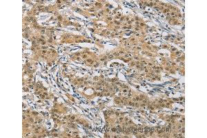 Immunohistochemistry of Human gastric cancer using NAPSA Polyclonal Antibody at dilution of 1:50