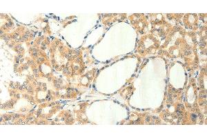 Immunohistochemistry of paraffin-embedded Human thyroid cancer using TRPM5 Polyclonal Antibody at dilution of 1:60 (TRPM5 anticorps)