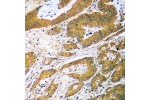 Immunohistochemical analysis of p53 staining in human colon cancer formalin fixed paraffin embedded tissue section. (p53 anticorps  (N-Term))
