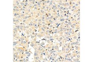 Immunohistochemistry of paraffin embedded human lung cancer using PTPN12 (ABIN7075292) at dilution of 1: 2500 (400x lens)