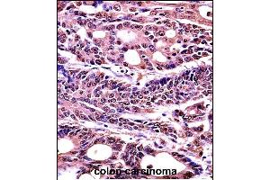 HMGB1 Antibody (C-term) (Ascites) (ABIN1536601)immunohistochemistry analysis in formalin fixed and paraffin embedded human colon carcinoma followed by peroxidase conjμgation of the secondary antibody and DAB staining.