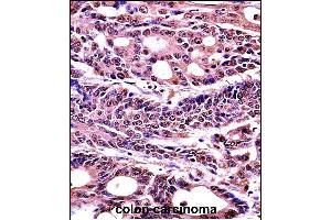 HMGB1 Antibody (C-term) (Ascites) (ABIN1536601)immunohistochemistry analysis in formalin fixed and paraffin embedded human colon carcinoma followed by peroxidase conjμgation of the secondary antibody and DAB staining. (HMGB1 anticorps  (C-Term))