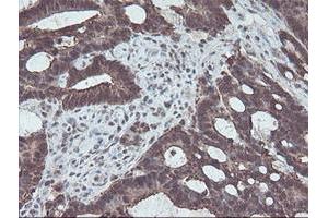 Immunohistochemical staining of paraffin-embedded Adenocarcinoma of Human colon tissue using anti-CBR3 mouse monoclonal antibody. (CBR3 anticorps)
