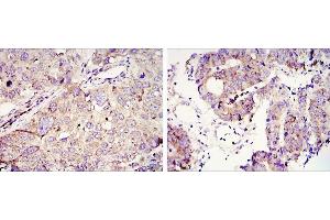 Immunohistochemical analysis of paraffin-embedded lung cancer (left) and colon tumour tissues (right) using IGC2BP3 mouse mAb with DAB staining. (IGF2BP3 anticorps)