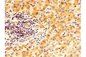 IHC image of ABIN7166409 diluted at 1:400 and staining in paraffin-embedded human liver cancer performed on a Leica BondTM system.