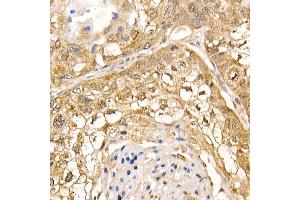 Immunohistochemistry of paraffin-embedded human lung cancer using UBB Rabbit pAb (ABIN6130181, ABIN6149775, ABIN6149776 and ABIN6222958) at dilution of 1:200 (40x lens). (UBASH3B anticorps  (AA 1-300))