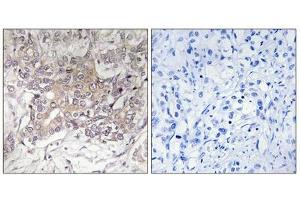 Immunohistochemistry analysis of paraffin-embedded human liver carcinoma tissue using GCNT3 antibody. (GCNT3 anticorps  (Internal Region))