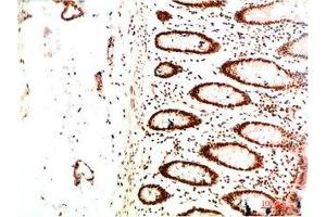 Immunohistochemical analysis of paraffin-embedded Human Colon Carcinoma Tissue using HP-1 α Mouse mAb diluted at 1:2000