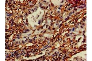 Immunohistochemistry of paraffin-embedded human lung cancer using ABIN7150140 at dilution of 1:100 (DRAM anticorps  (AA 50-100))