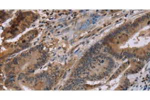 Immunohistochemistry of paraffin-embedded Human colon cancer tissue using FAM107A Polyclonal Antibody at dilution 1:30 (FAM107A anticorps)