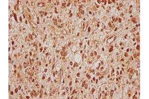 IHC image of ABIN7170677 diluted at 1:100 and staining in paraffin-embedded human glioma cancer performed on a Leica BondTM system.
