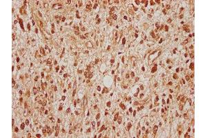 IHC image of ABIN7170677 diluted at 1:100 and staining in paraffin-embedded human glioma cancer performed on a Leica BondTM system. (SRPK2 anticorps  (AA 471-688))