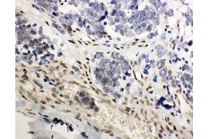 IHC-P: GR antibody testing of human lung cancer tissue (GR (AA 20-199) anticorps)