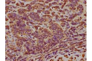 IHC image of ABIN7152141 diluted at 1:300 and staining in paraffin-embedded human ovarian cancer performed on a Leica BondTM system.