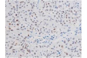 ABIN6267508 at 1/200 staining Human lung cancer tissue sections by IHC-P.