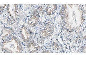 ABIN6276723 at 1/100 staining Human prostate tissue by IHC-P. (NAT1 anticorps  (Internal Region))