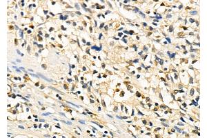 ABIN6260794 and ABIN6278439 at 1/100 staining Human colorectal cancer by IHC-P. (CHD1L anticorps  (Internal Region))