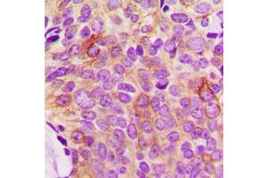 Immunohistochemical analysis of Osteoprotegerin staining in human breast cancer formalin fixed paraffin embedded tissue section.