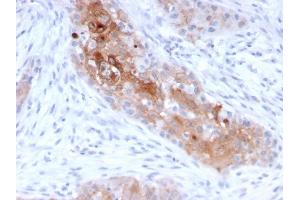 Formalin-fixed, paraffin-embedded human Bladder Carcinoma stained with Desmoglein-1 Mouse Monoclonal Antibody (32-2B). (Desmoglein 1 anticorps)