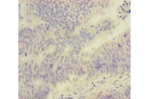 Immunohistochemistry of paraffin-embedded human colon cancer using ABIN7152525 at dilution of 1:100 (FOXRED1 anticorps  (AA 307-486))