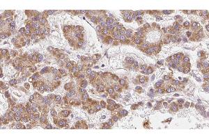 ABIN6273985 at 1/100 staining Human liver cancer tissue by IHC-P. (OR2V2 anticorps  (Internal Region))