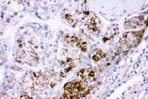 IHC-P: CBS antibody testing of human liver cancer tissue