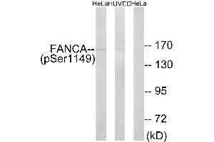 Immunohistochemistry analysis of paraffin-embedded human colon carcinoma tissue using FANCA (Phospho-Ser1149) antibody. (FANCA anticorps  (pSer1149))