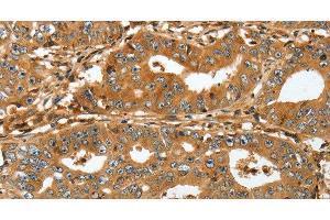 Immunohistochemistry of paraffin-embedded Human gastric cancer tissue using RAP1A Polyclonal Antibody at dilution 1:45 (RAP1A anticorps)