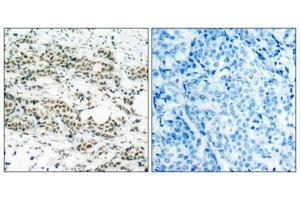 Immunohistochemical analysis of paraffin-embedded human breast carcinoma tissue using AFX(Phospho-Ser197) Antibody(left) or the same antibody preincubated with blocking peptide(right).