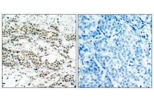 Immunohistochemical analysis of paraffin-embedded human breast carcinoma tissue using AFX(Phospho-Ser197) Antibody(left) or the same antibody preincubated with blocking peptide(right). (FOXO4 anticorps  (pSer197))